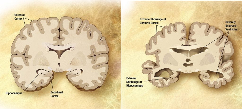 Alzheimer's disease brain changes