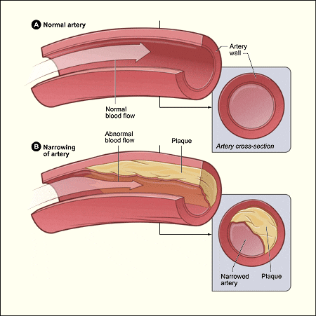 atherosclerosis plaque build up