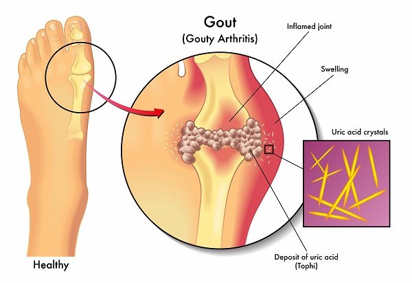 what is gout in the toe