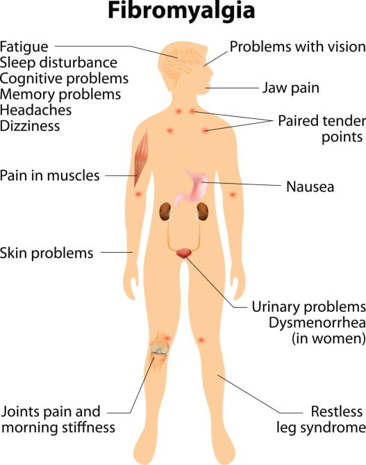 fibromyalgia signs and symptoms.