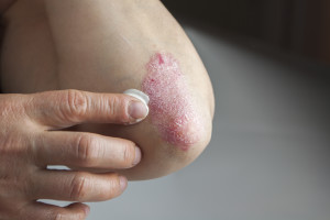 certain foods cause skin conditions like eczema