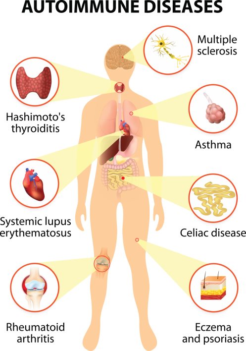 Autoimmune disease Hashimotos