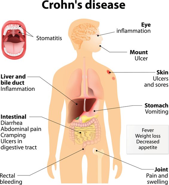 Crohns disease symptoms