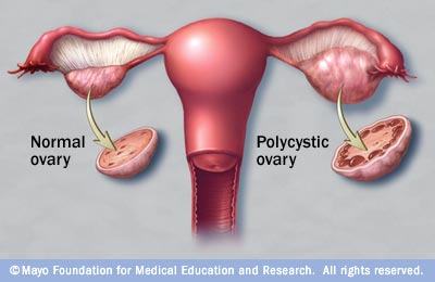 what is PCOS