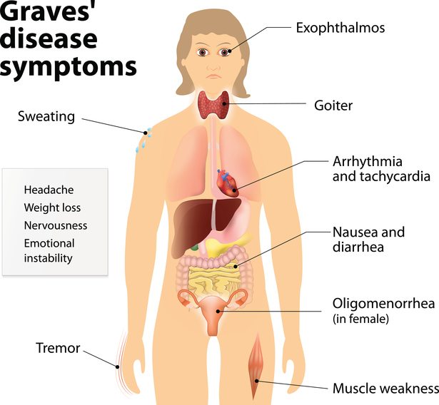 Graves' disease symptoms