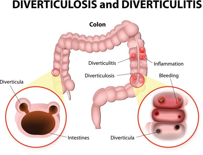 Diverticulosis and Diverticulitis