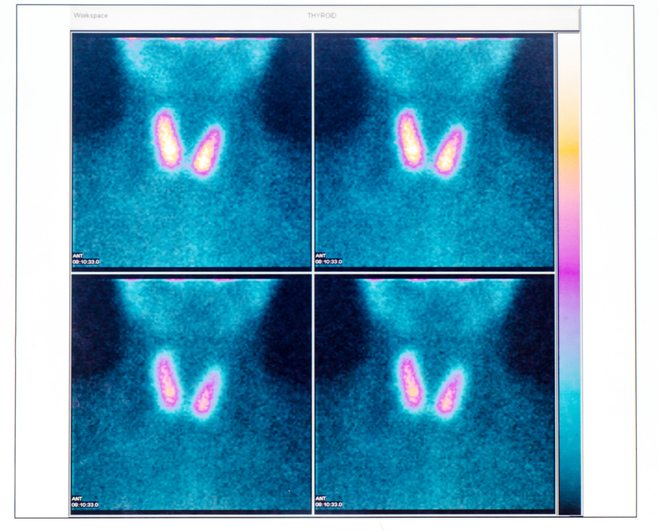 Tests For Measuring T4 and T3