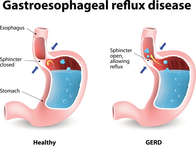 Gastroesophageal Reflux Disease (GERD)