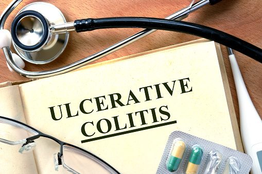 Ulcerative Colitis Symptoms and Causes