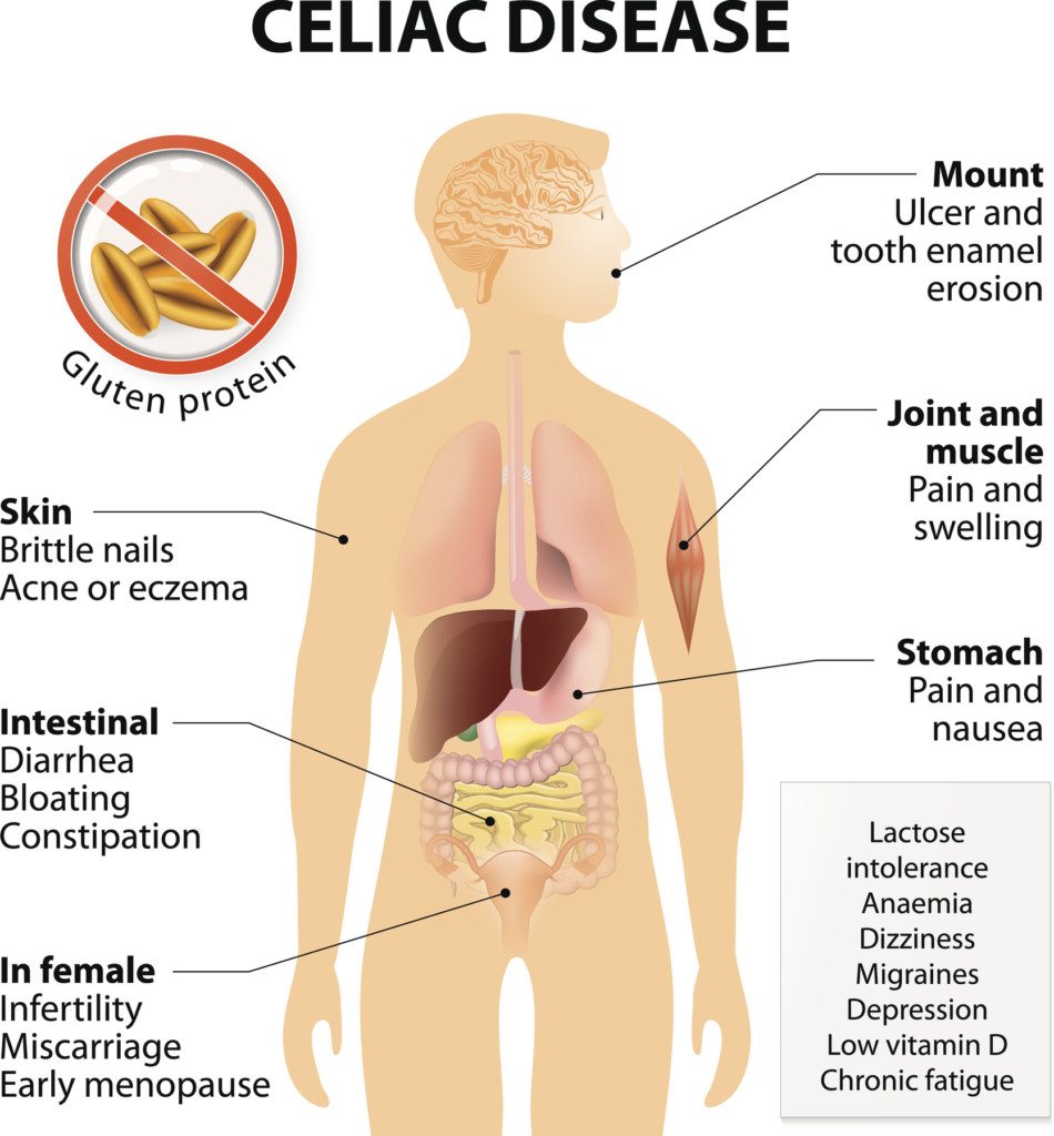  celiac disease symptoms