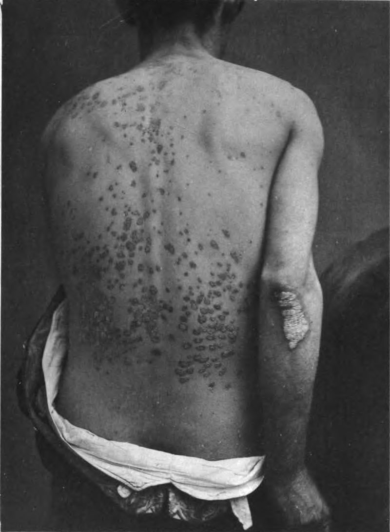 Guttate psoriasis