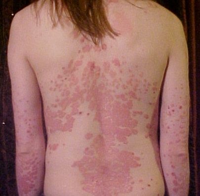 Psoriasis_on_back1