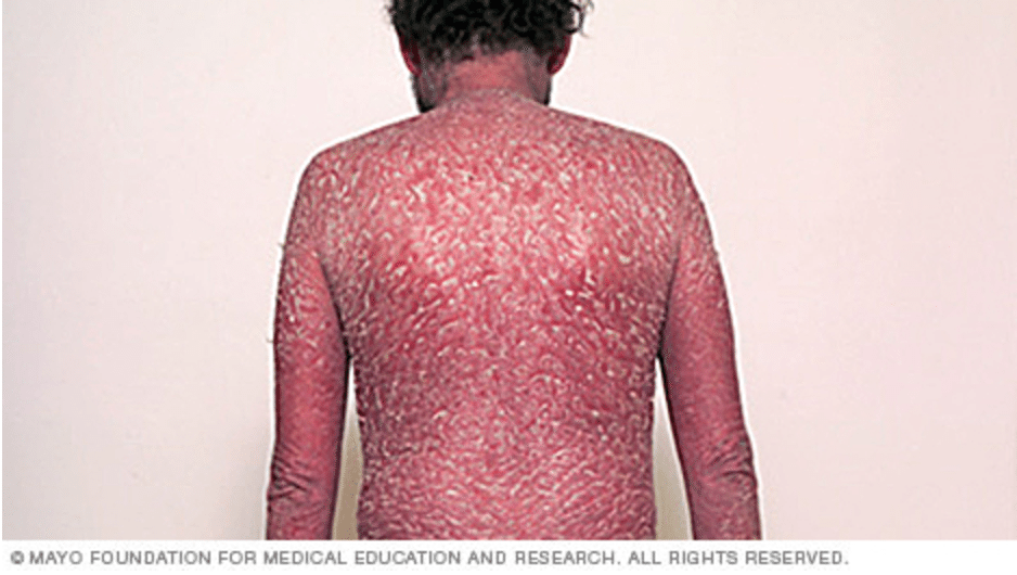 Erythrodermic psoriasis