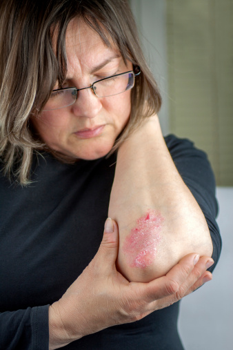 What is Psoriasis and Its Symptoms