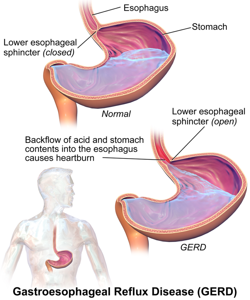 Betaine HCl, Acid Reflux, and Functional Dyspepsia