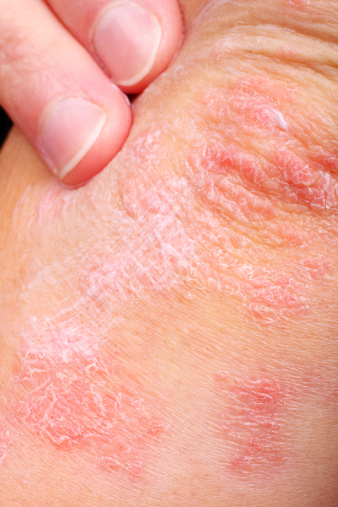 What is Eczema?