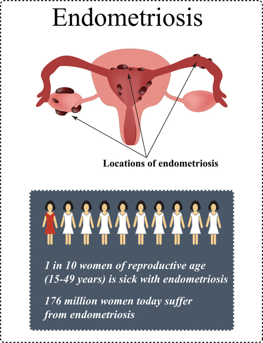 Endometriosis prevalence