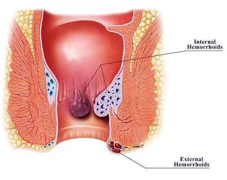 Diagnosing Hemorrhoids