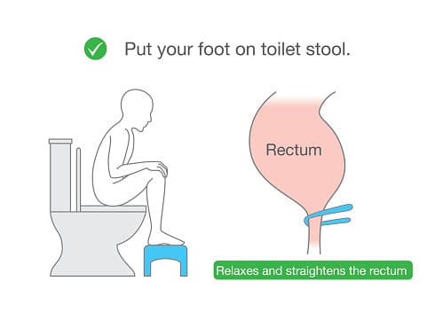 Squatty potty for hemorrhoids