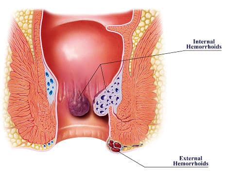 Types of hemorrhoids internal or external