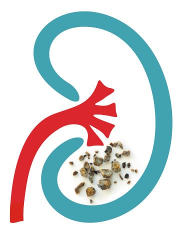 Potassium Citrate and Kidney Stones