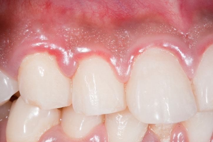 What is Gingivitis?