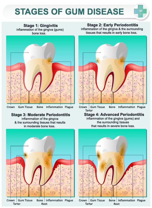 gingivitis treatment