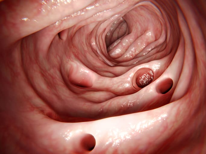 What Causes Pseudomembranous Colitis (C. diff Colitis)?