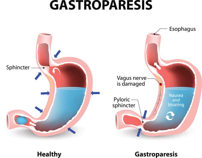 gastroparesis diet stage 1 heti etrend cukorbetegek