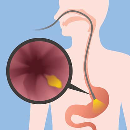 Is there a way to determine SIBO without those breath tests