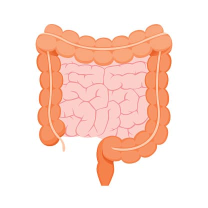 What is Fecal Impaction?