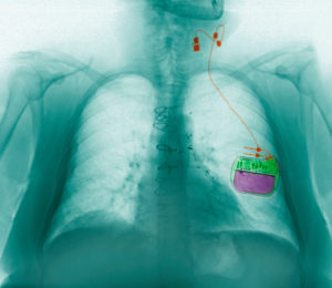 Vagus Nerve Testing