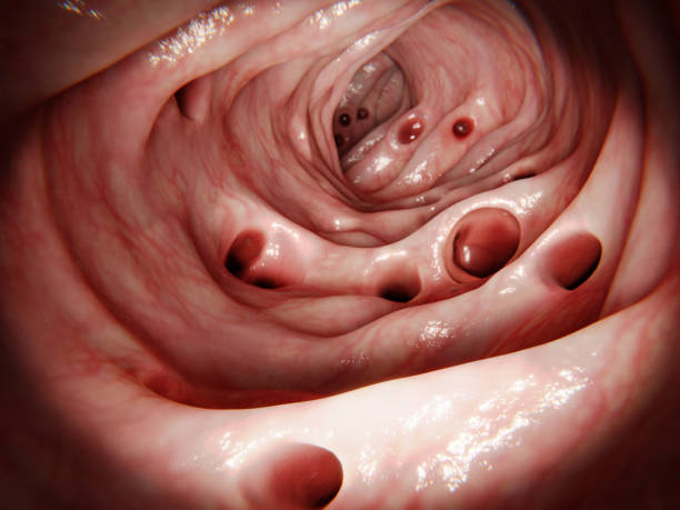 Diverticula in the large intestine. Diverticulitis results of the inflammation of one of these diverticula. The most common sympton is abdominal pain."n