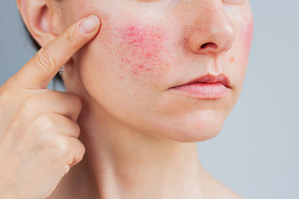 Image of a dietitian holding a stack of papers in hand which are test results. Young Caucasian woman suffering from rosacea on her face in the acute stage, she showing redness on her cheek. Skin chronic disease.